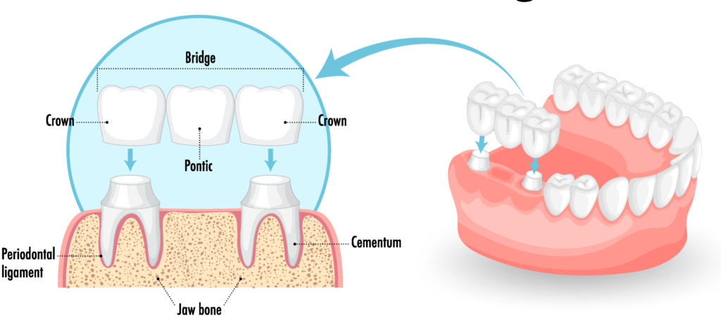 Dental bridge treatment in Sun City, AZ