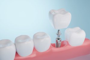 dental implant shown on model teeth