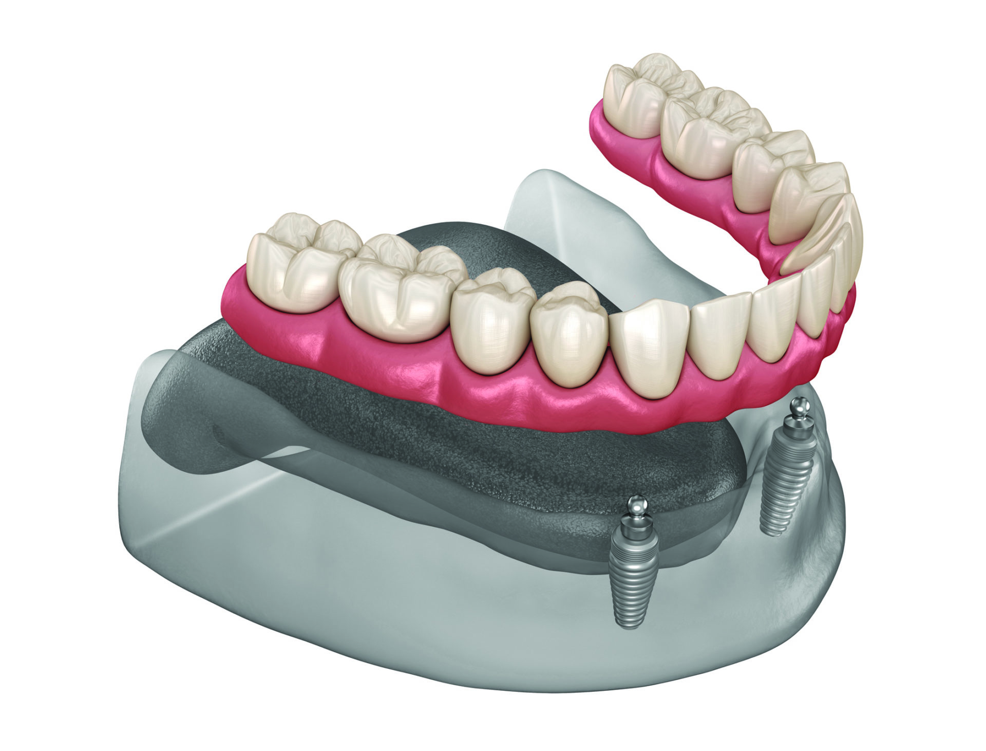 Snap On Dentures Burns Dentistry