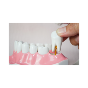 tooth extraction being demonstrated on model of mouth