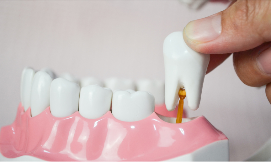 Bone Graft Burns Dentistry