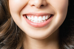 Picture of a woman smiling with white teeth.