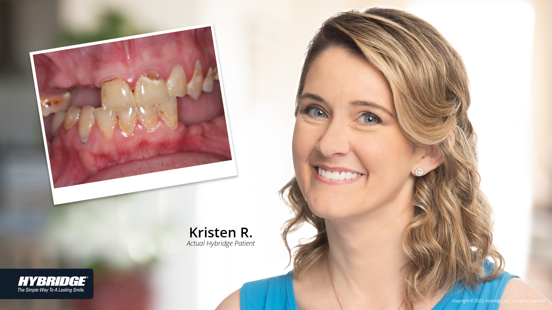 Understanding Dental Implants Burns Dentistry
