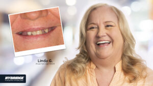 Before-and-after Hybridge implants in Sun City West, AZ