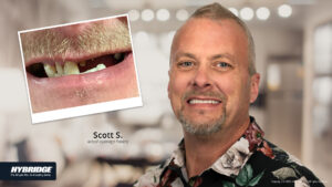 Before-and-after Hybridge implants in Sun City, AZ